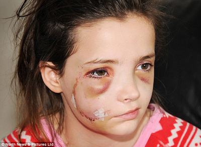 英国13岁少女被德国牧羊犬袭击近乎毁容(图)-