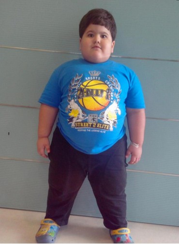 印4岁肥胖症男孩重88斤胃切除手术后成功瘦身
